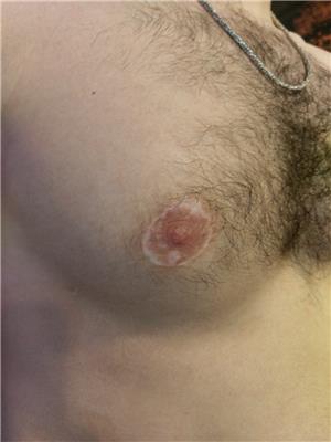 erkek-meme-kucultme-ameliyati-jinekomasti-sonrasi-meme-ucu-kesi-izlerinin-areola-dovmesi-ile-kapatilmasi---after-jinekomasti-scar-nipple-areola-tattoo