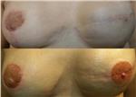 mikropigmentasyonla-rekonstruksiyon-meme-ucu-dovmesi---nipple-areola-tattoo