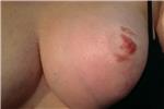 meme-ucu-dovmesi---nipple-areola-tattoo