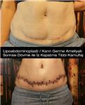 lipoabdominoplasti-karin-germe-ameliyati-sonrasi-dovme-ile-iz-kapatma-tibbi-kamuflaj-