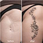 bacak-kesik-yara-izi-uzerine-cicek-yaprak-dovmeleri