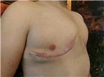 erkek-meme-kucultme-ameliyati-jinekomasti-sonrasi-meme-ucu-kaybinin-areola-dovmesi-ile-yapilandirilmasi---after-jinekomasti-nipple-areola-tattoo