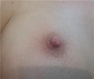 estetik-amacli-meme-ucu-dovmesi---nipple-areola-tattoo