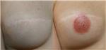 mikropigmentasyonla-rekonstruksiyon-meme-ucu-dovmesi---nipple-areola-tattoo