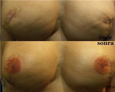 mikropigmentasyonla-rekonstruksiyon-meme-ucu-dovmesi---nipple-areola-tattoo