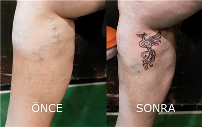 varis-uzerine-anka-kusu-dovmesi---varicose-vein-phoenix-tattoo