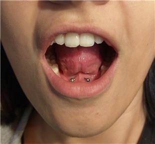 Frenulum Dil Alt Piercing / Frenulum Under Tongue Piercing