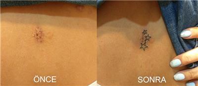 gobek-deligi-etrafina-yildiz-dovmesi---navel-star-tattoos