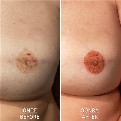 meme-kanseri-nedeniyle-mastektomi-sonrasi-meme-ucu-areola-dovmesi---nipple-areola-tattoo