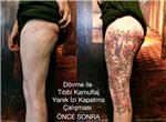 dovme-ile-yanik-izi-kapatma-calismasi---burn-scar-tattoo-on-leg