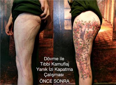 dovme-ile-yanik-izi-kapatma-calismasi---burn-scar-tattoo-on-leg