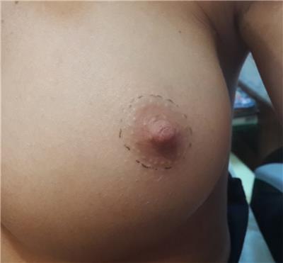 estetik-amacli-meme-ucu-dovmesi---nipple-areola-tattoo