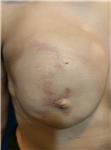 mikropigmentasyonla-rekonstruksiyon-meme-ucu-dovmesi---nipple-areola-tattoo