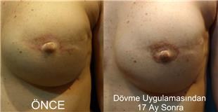 Mikropigmentasyonla Rekonstrksiyon Meme Ucu Dvmesi / Nipple Areola Tattoo