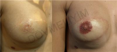 3-boyutlu-mikropigmentasyonla-rekonstruksiyon-meme-ucu-dovmesi---3d-nipple-areola-tattoo