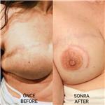 meme-kanseri-nedeniyle-mastektomi-sonrasi-meme-ucu-areola-dovmesi---brest-cancer-nipple-areola-tattoo