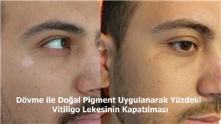 Vitiligo zerine Dvme ile Doal Pigment Uygulamas / Vitiligo Tattoo