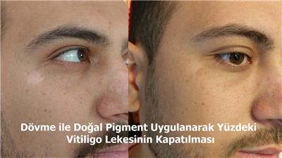 vitiligo-uzerine-dovme-ile-dogal-pigment-uygulamasi---vitiligo-tattoo