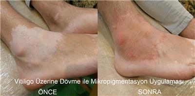 vitiligo-uzerine-ten-rengi-dovme-uygulamasi---vitiligo-tattoo