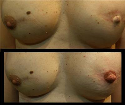 mikropigmentasyonla-rekonstruksiyon-meme-ucu-dovmesi---nipple-areola-tattoo