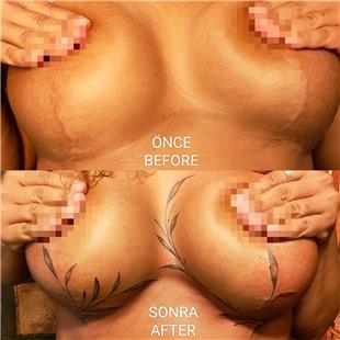 Meme Kltme Ameliyat Sonras Dvme ile z Kapatma almas / Breast Reduction Scar Cover Up Tattoo