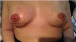 meme-ucu-dovmesi---nipple-areola-tattoo