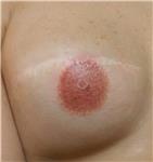 mikropigmentasyonla-rekonstruksiyon-meme-ucu-dovmesi---nipple-areola-tattoo