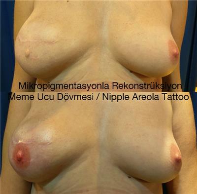 mikropigmentasyonla-rekonstruksiyon-meme-ucu-dovmesi---nipple-areola-tattoo