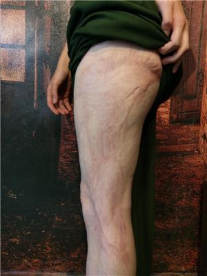 dovme-ile-yanik-izi-kapatma-calismasi---burn-scar-tattoo-on-leg