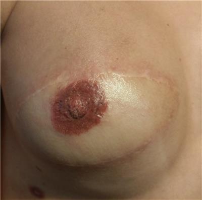 3-boyutlu-mikropigmentasyonla-rekonstruksiyon-meme-ucu-dovmesi---3d-nipple-areola-tattoo