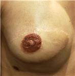3-boyutlu-mikropigmentasyonla-rekonstruksiyon-meme-ucu-dovmesi---3d-nipple-areola-tattoo