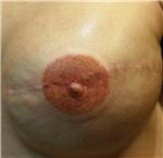 mikropigmentasyonla-rekonstruksiyon-meme-ucu-dovmesi---nipple-areola-tattoo