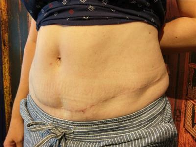 lipoabdominoplasti-karin-germe-ameliyati-sonrasi-dovme-ile-iz-kapatma-tibbi-kamuflaj-