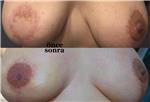 mikropigmentasyonla-rekonstruksiyon-meme-ucu-dovmesi---nipple-areola-tattoo