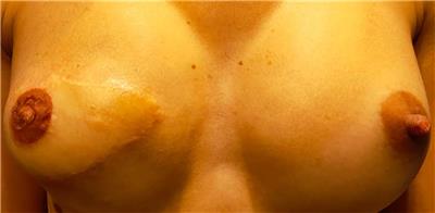 3-boyutlu-mikropigmentasyonla-rekonstruksiyon-meme-ucu-dovmesi---3d-nipple-areola-tattoo