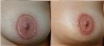 meme-ucu-ameliyat-izi-mikropigmentasyonla-kapatma-dovmesi---nipple-areola-scar-tattoo