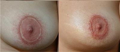 meme-ucu-ameliyat-izi-mikropigmentasyonla-kapatma-dovmesi---nipple-areola-scar-tattoo