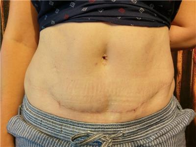 lipoabdominoplasti-karin-germe-ameliyati-sonrasi-dovme-ile-iz-kapatma-tibbi-kamuflaj-