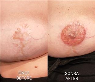 Meme Kltme Ameliyat Sonras Dvme ile Meme Ucu Areola Tamamlama almas