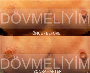 Meme K���ltme Ameliyat� Sonras� D�vme ile Meme Ucu Areola Tamamlama �al��mas�