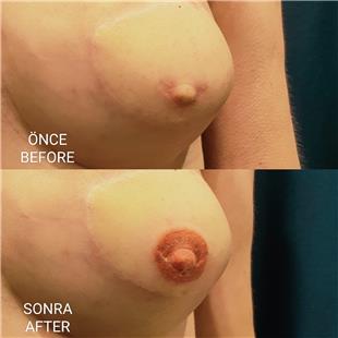 Meme Kanseri Nedeniyle Mastektomi Sonrası Meme Ucu Areola Dövmesi / Brest Cancer Nipple Areola Tattoo