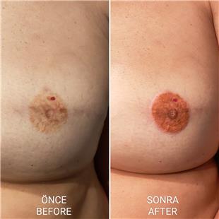 Meme Kanseri Nedeniyle Mastektomi Sonras Meme Ucu Areola Dvmesi / Nipple Areola Tattoo