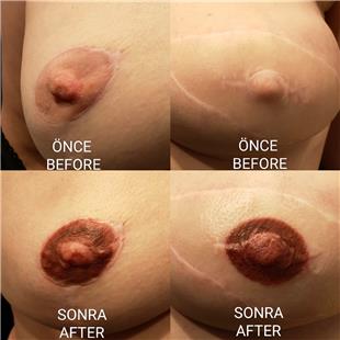 Meme Kanseri Nedeniyle Mastektomi Sonras Meme Ucu Areola Dvmesi / Nipple Areola Tattoo
