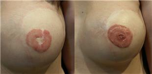 Mikropigmentasyonla Rekonstrüksiyon Meme Ucu Dövmesi / Nipple Areola Tattoo