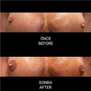 Mikropigmentasyonla Rekonstrksiyon Meme Ucu Dvmesi / Nipple Areola Tattoo
