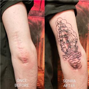 Gemi ile Yara zi Kapatma Dvmesi / Scar Tattoo