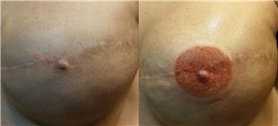 Mikropigmentasyonla Rekonstrüksiyon Meme Ucu Dövmesi / Nipple Areola Tattoo