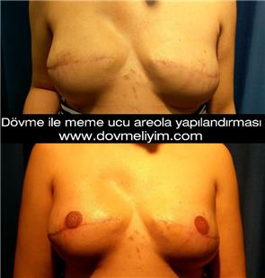Göğüs Kanseri Riski Nedeniyle Mastektomi Sonrası Meme Ucu Dövmesi / Nipple Areola Tattoo