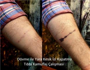 Ok Dövmesi ile Yara Kesik İzi Kapatma Çalışması / Arrow Scar Tattoos