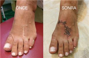 Ayak zeri Diki zi iek Dvmesi ile Kapatma / Scar Tattoo Cover Up with Flower